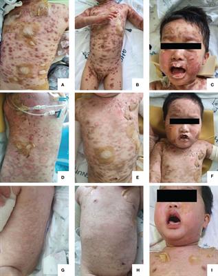 Etanercept treatment for pediatric toxic epidermal necrolysis induced by deflazacort: a case report and literature review